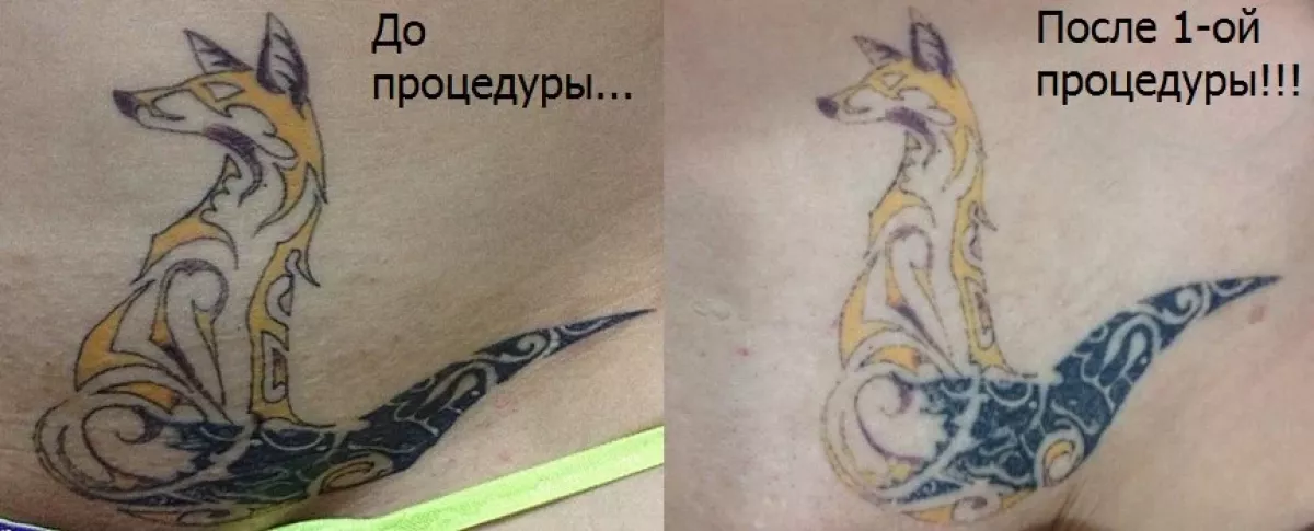 Карбоновый пилинг фото 1